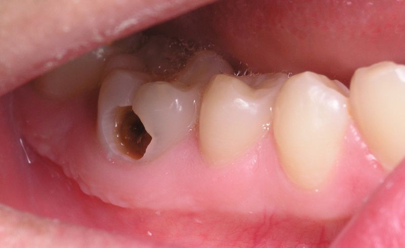 Trẻ chậm mọc răng gây sâu răng - Angelpro.vn