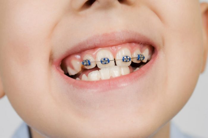 Niềng răng mang đến hiệu quả cao cho răng mọc lệch